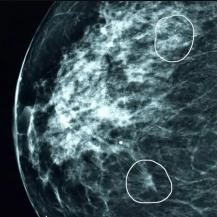 Mamografia em preto e branco com dois círculos brancos destacando áreas suspeitas detectadas pela IA.